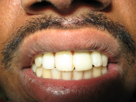 After treatment dental outcome
